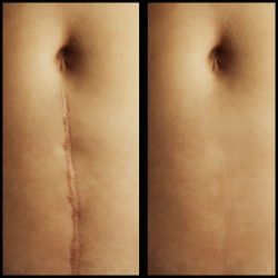 scar reduction as part of cosmetic surgery therapy