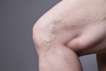 varicose vein leg swelling therapy Albuquerque 