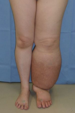 difference between edema and lymphedema - Manual Lymphatic Drainage Albuquerque