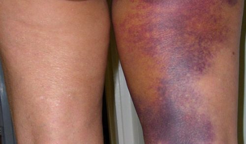 Abq Surgical Recovery Therapy - post-operative bruising and swelling relief after surgery Albuquerque 