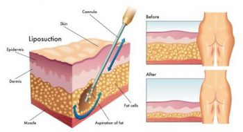 liposuction for lipedema