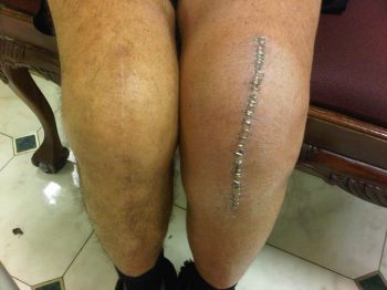 knee replacement swelling