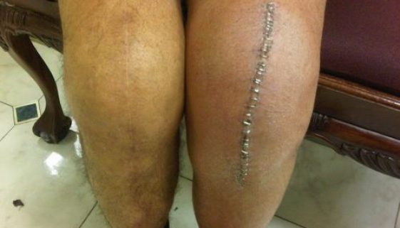Knee replacement - both legs. Leg on the left shows signs of permanent fibrosis due to prolonged swelling.