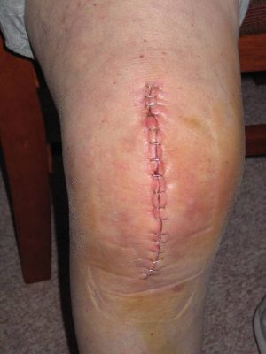 knee replacement recovery therapy Albuquerque swelling pain 