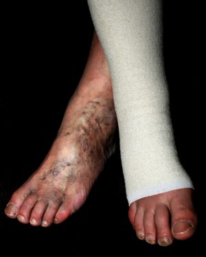 Compression Garment for Varicose Veins - who are our clients