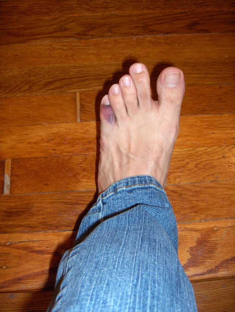 swelling from stubbed toe