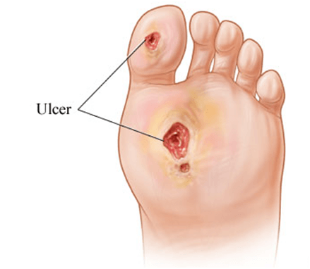 PEMF Therapy Benefits for Diabetic Foot Ulcers - PEMF for ulcers