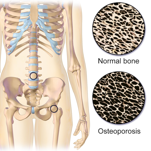 PEMF Treatment for Osteoporosis