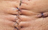 scar from abdominal surgery can lead to deep adhesions that can cause pain and twist vital organs - scars can cause dangerous adhesions - heal scars Albuquerque 