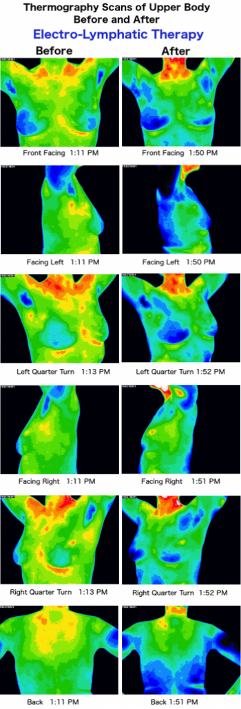 Thermography Scans of the upper body before and after Electro-Lymphatic Therapy