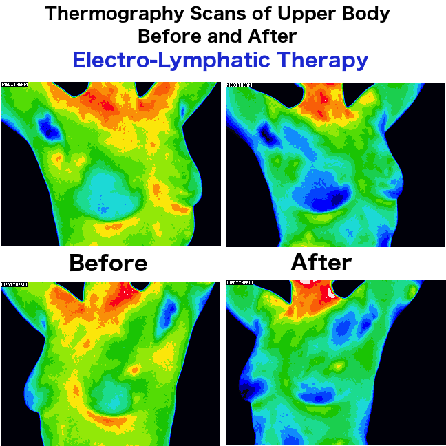 Thermography Scans before and after electro-lymphatic therapy