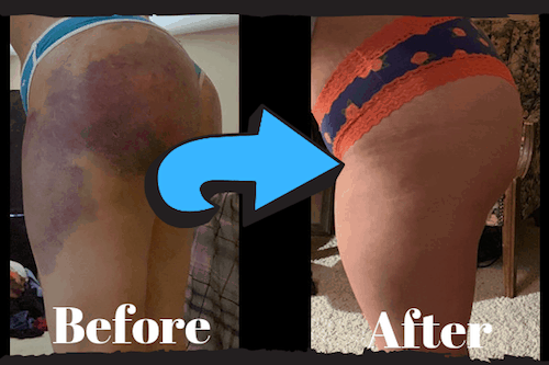 Before & After Lymphatic Massage Bruise from BBL Recovery Albuquerque