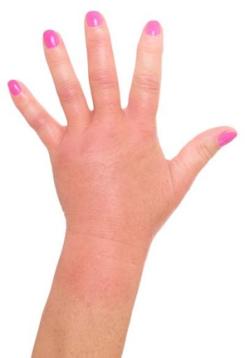 swelling of the hand after plastic surgery