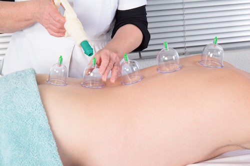 Kangzhu Cups with suction gun - Cupping Therapy Albuquerque - Pain & Swelling Solutions