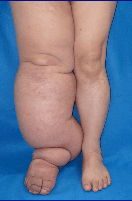 Late Stage Lymphedema Symptoms 