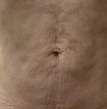 fibrosis after liposuction abdominal