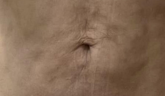 How to Get Rid of Fibrosis After Lipo