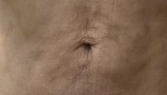 fibrosis after liposuction abdominal