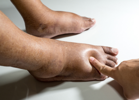 swollen feet - swelling relief - Pain & Swelling Solutions Abq 
