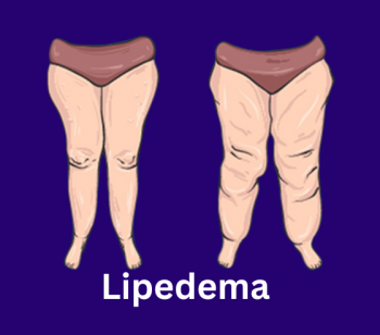 lymphedema therapy