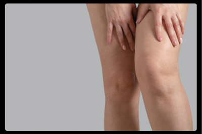 Leg Swelling - Do vein problems cause swelling Leg Swelling - Do vein problems cause swelling
